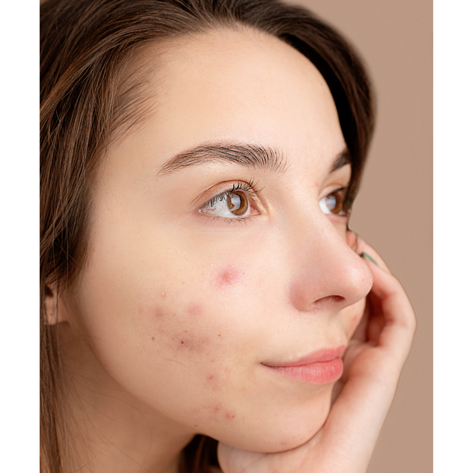 L’acné : les causes, les symptômes et les différentes formes